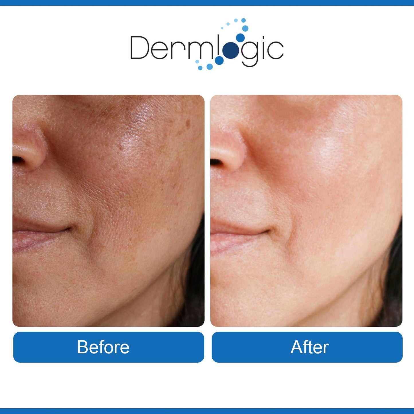 Anti Aging Resurfacing Peel Pads- Triple Action Chemical Peel Pads Combined with Glycolic, Lactic, and Salicylic Acids. Smooth’s Fine Lines, Wrinkles, Dark Spots, and Imperfections to Enhance the Skin