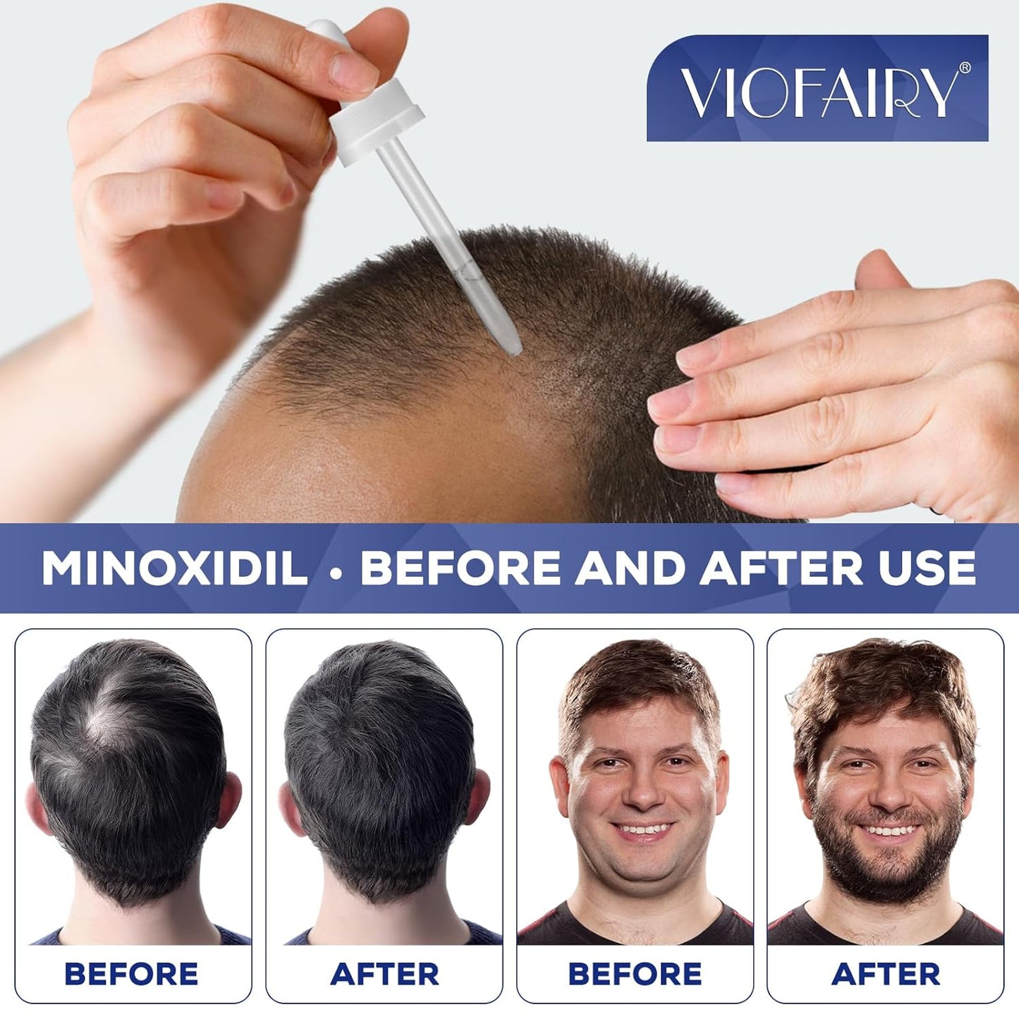 5% Minoxidil for Men and Women, Hair Regrowth Treatment for Thinning Hair and Hair Loss, Topical Solution - 2 Months Supply - Dermatologist recommended (Pack of 2)