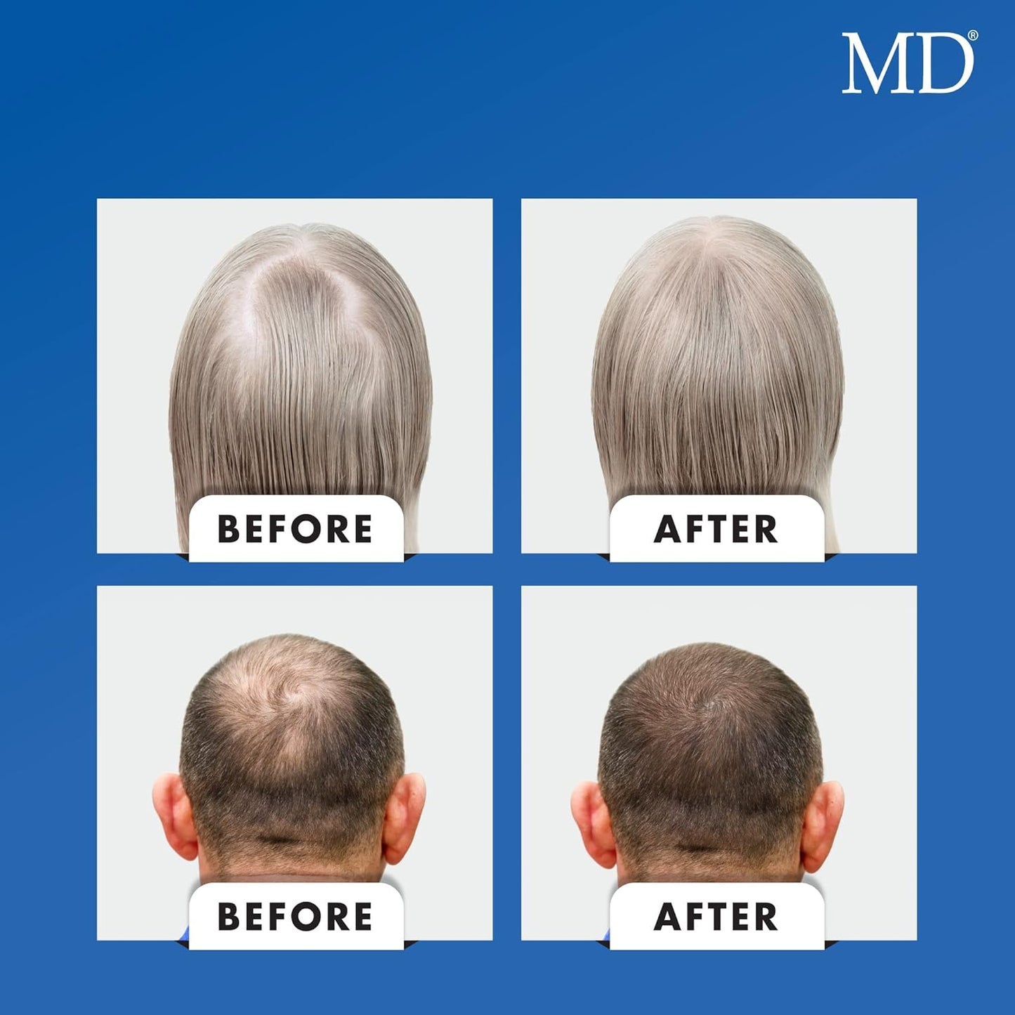 MD Nutri Hair Growth Supplement con biotina (30 cápsulas) | Previene la caída del cabello, minimiza la caída del cabello, el adelgazamiento, la rotura y promueve el cabello más largo y grueso | Formul