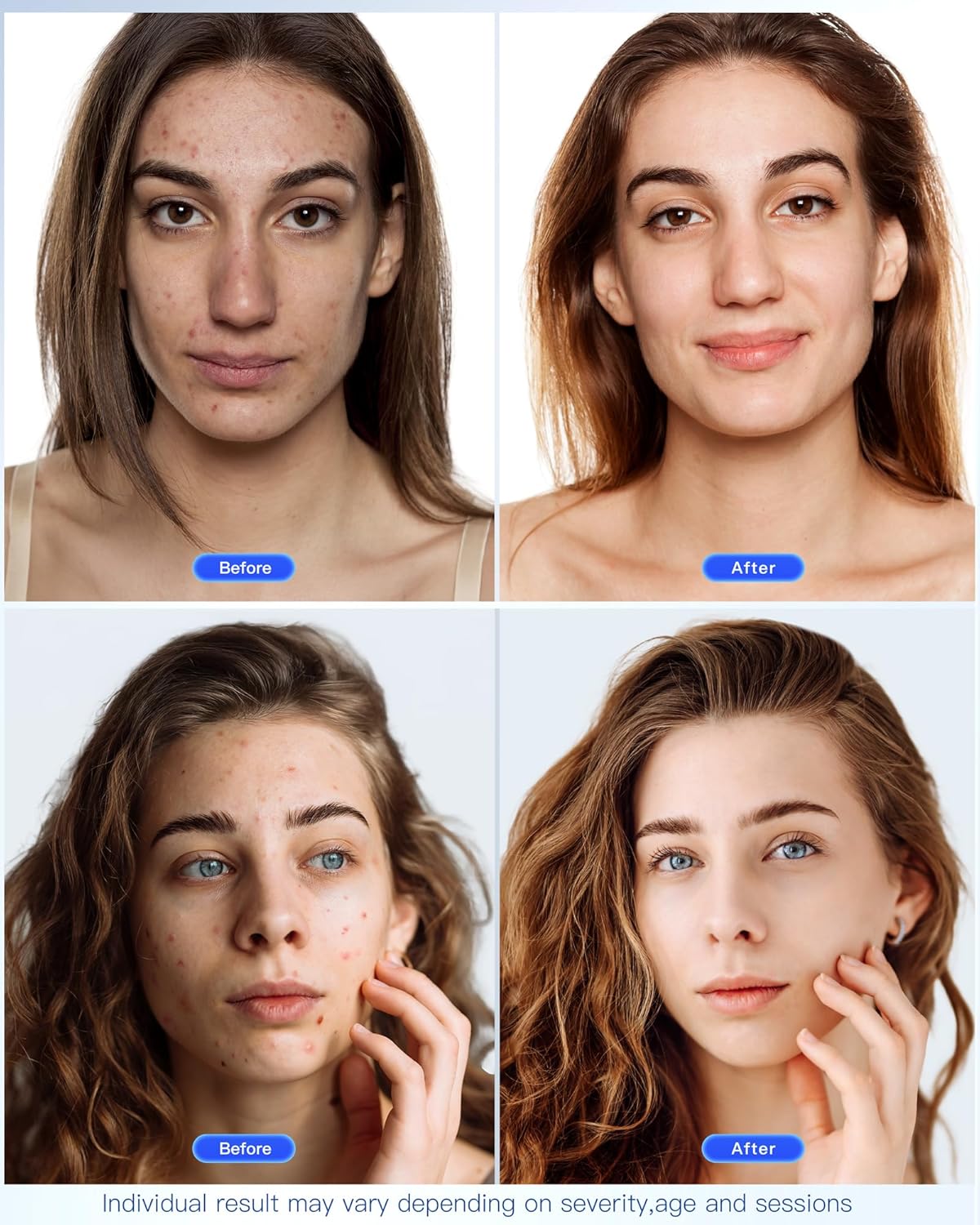 NEWKEY LED Face Mask Light Therapy,Red Light Therapy for Face Wrinkle Blue Light Therapy Mask for Face Acne,150LEDs,10 Min Auto Shut off, Wired