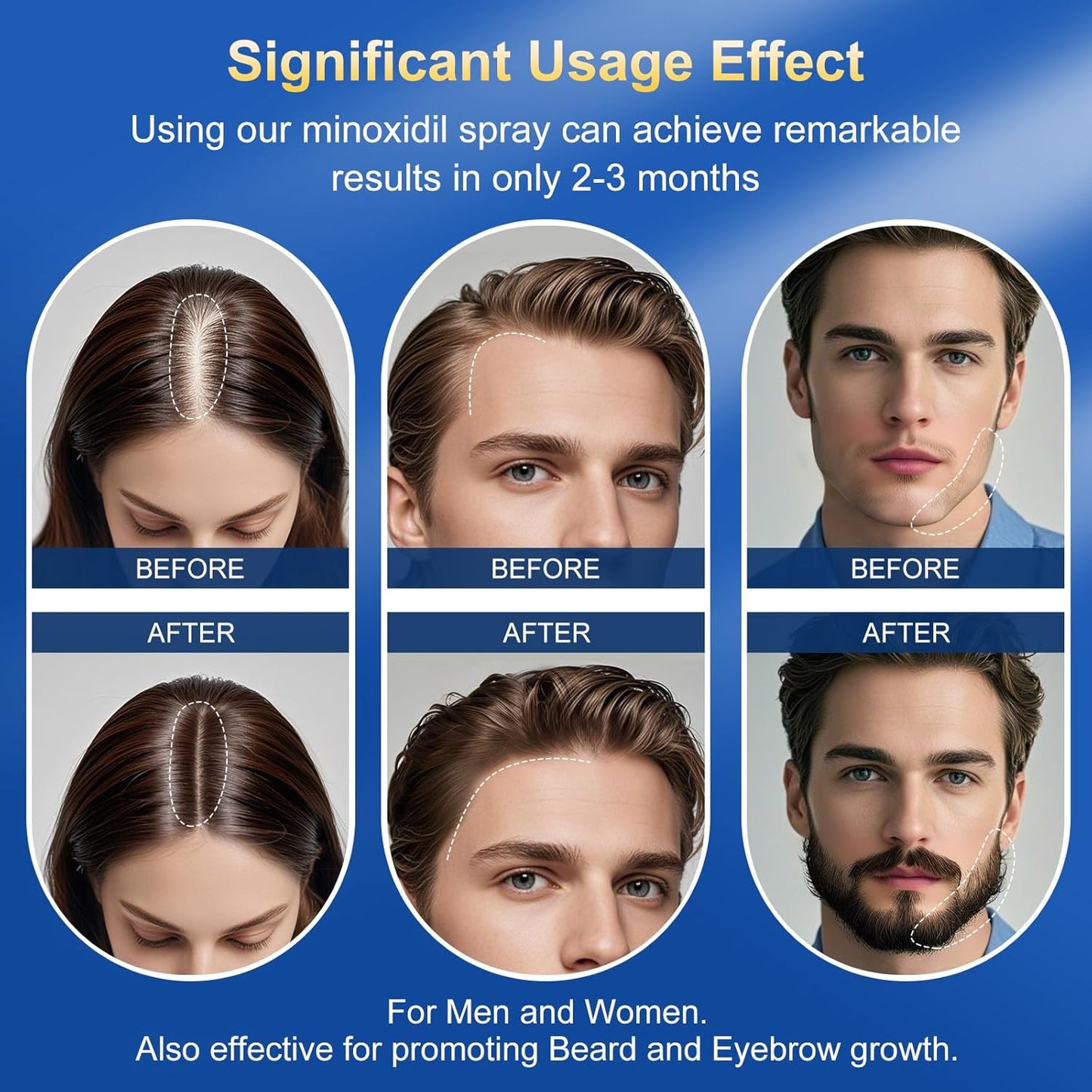 5% Minoxidil for Men & Women | Hair Growth Oil Spray | 5-Pack (17.5 fl oz) | 8 Month Supply | Hair Regrowth & Beard Growth Treatment with Biotin | Clinically Proven Extra Strength Formula